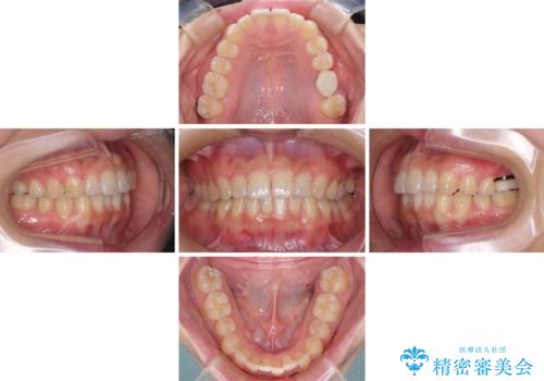 インプラントによる補綴治療とインビザライン矯正の治療中