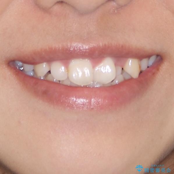 インビザラインが続けられない ワイヤー装置での矯正治療の治療前(顔貌)