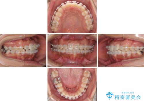 インビザラインが続けられない ワイヤー装置での矯正治療の治療中