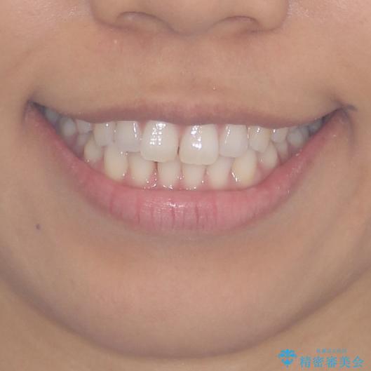 受け口傾向の前歯　すきっ歯の改善の治療前（顔貌）