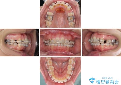 口元をスッキリと ワイヤー装置による抜歯矯正の治療中
