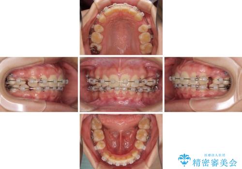 部分矯正で出っ歯になった 出っ歯改善の抜歯矯正の治療中