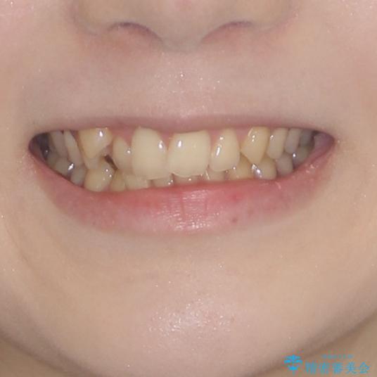 八重歯を短期間で改善　ワイヤー装置による抜歯矯正の治療前（顔貌）