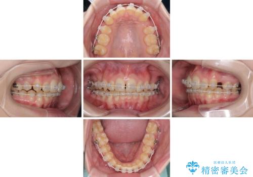 八重歯を短期間で改善 ワイヤー装置による抜歯矯正の治療中