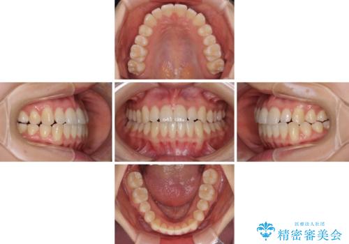 前歯のクロスバイト インビザラインによる矯正治療の治療中