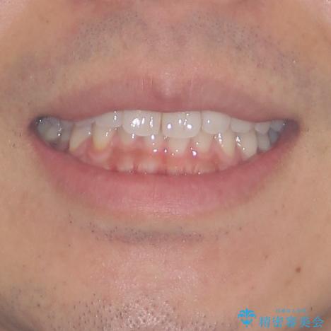 細かい隙間にものがはさまる インビザラインによる矯正治療の治療前(顔貌)