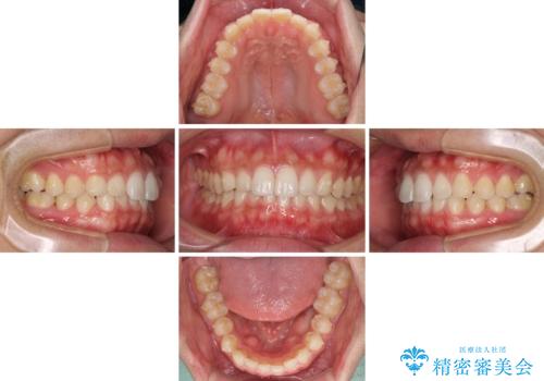 細かい隙間にものがはさまる インビザラインによる矯正治療の治療中