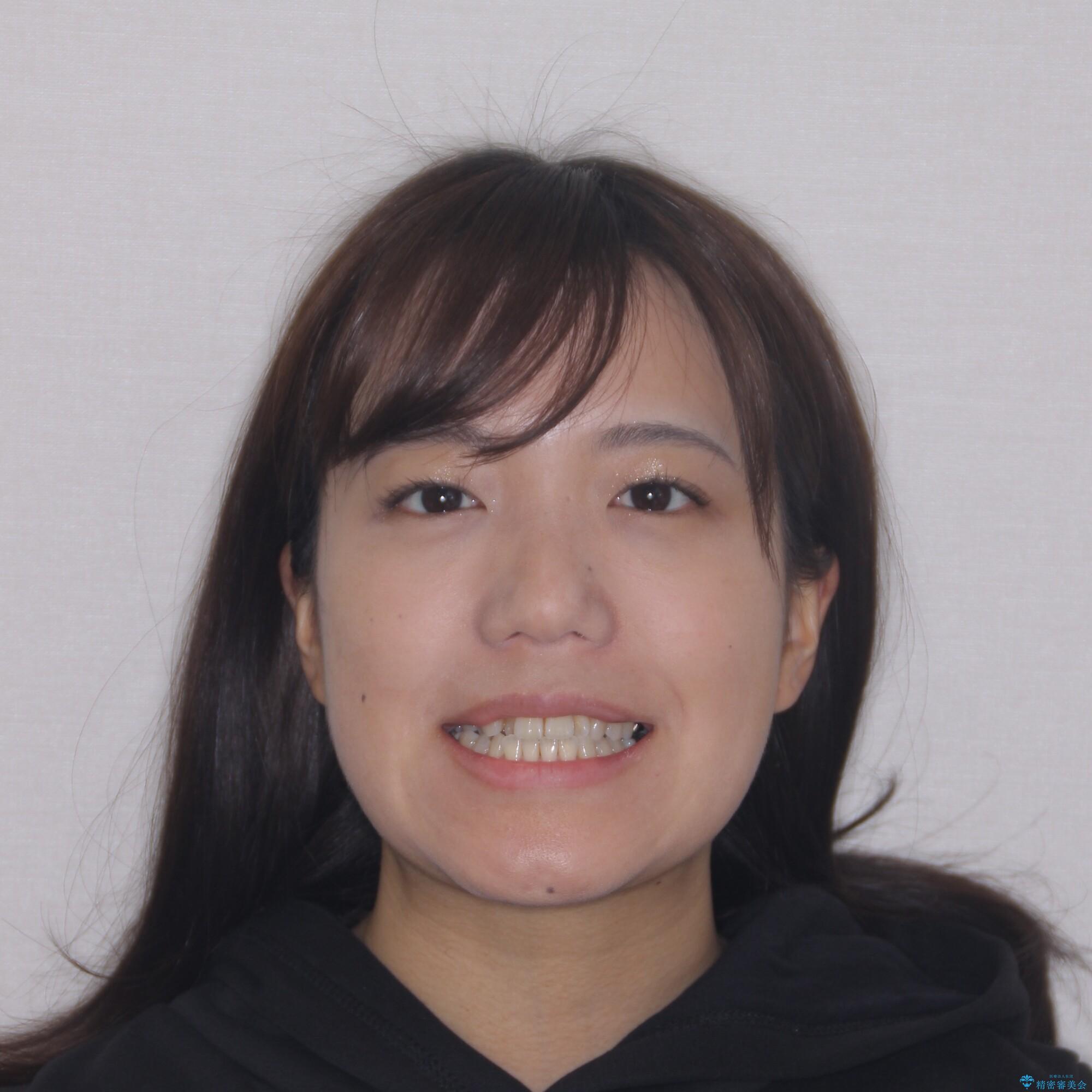 【モニター】幅の狭い上顎歯列 骨幅を拡大する矯正治療の治療前(顔貌)