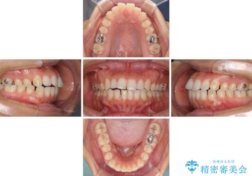 受け口傾向の前歯 すきっ歯の改善の治療中