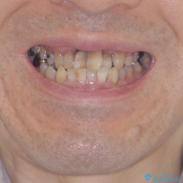 上顎の狭窄歯列　インビザラインによる拡大矯正の治療前（顔貌）