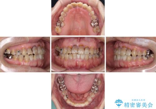 上顎の狭窄歯列 インビザラインによる拡大矯正の治療中