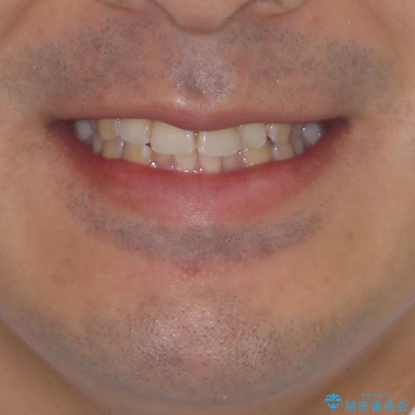 ディープバイトと叢生を解消 インビザライン矯正の治療前(顔貌)