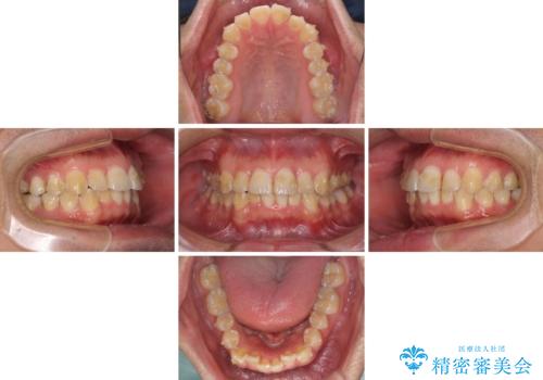 ディープバイトと叢生を解消 インビザライン矯正の治療中