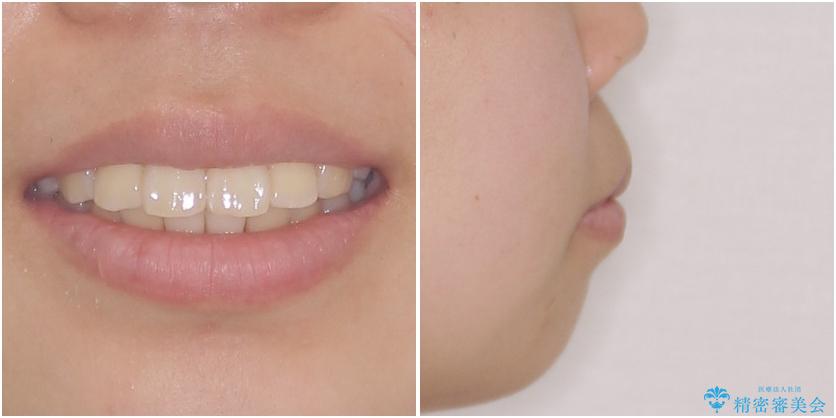 部分矯正で出っ歯になった　出っ歯改善の抜歯矯正の治療前（顔貌）