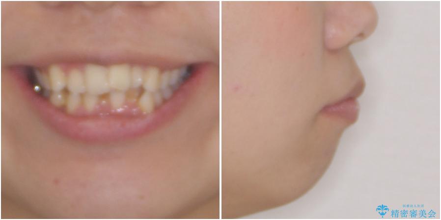 口元をスッキリと　ワイヤー装置による抜歯矯正の治療前（顔貌）