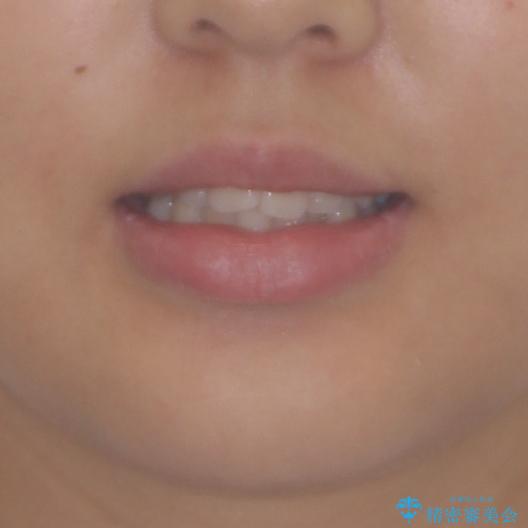 前歯のデコボコを改善　インビザライン矯正の治療前（顔貌）