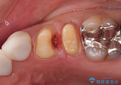 縁下カリエス オールセラミッククラウンの症例 治療前