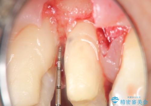 縁下カリエス オールセラミッククラウンの治療中