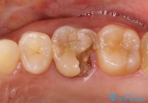 大きい虫歯　根管治療〜オールセラミッククラウンの症例 治療前