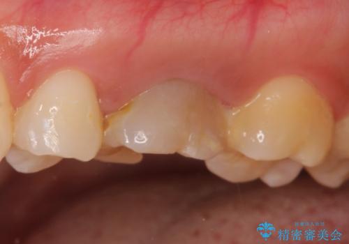 大きい虫歯 根管治療〜オールセラミッククラウンの治療前