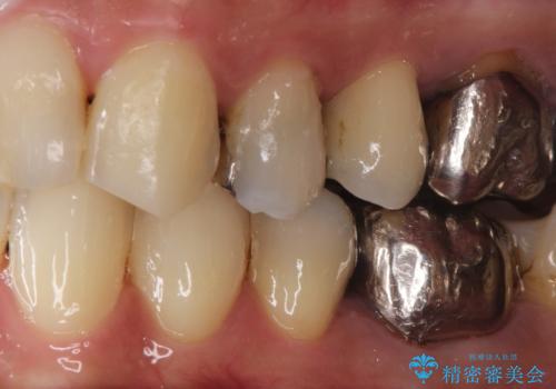 大きい虫歯 根管治療〜オールセラミッククラウンの治療前