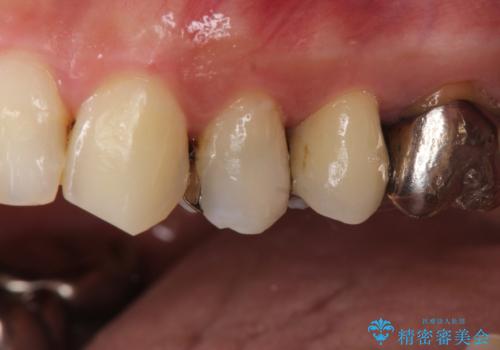 大きい虫歯 根管治療〜オールセラミッククラウンの治療前