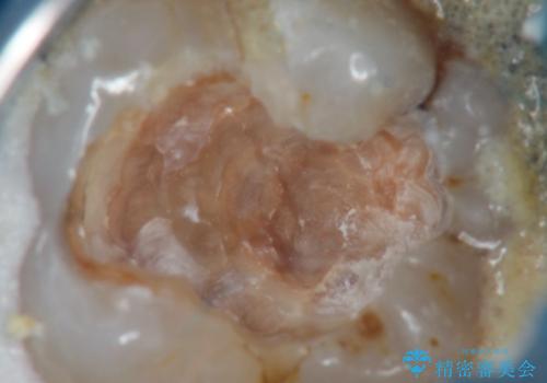 奥の歯茎にニキビみたいなものができた!の治療前