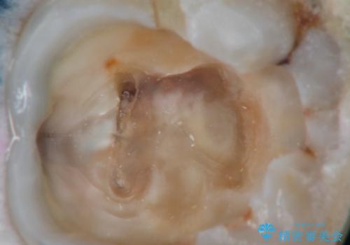 奥の歯茎にニキビみたいなものができた!の治療中