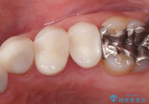 縁下カリエス オールセラミッククラウンの症例 治療後