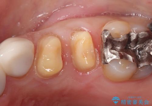 縁下カリエス オールセラミッククラウンの治療中