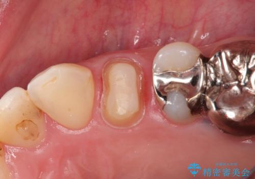 大きい虫歯 根管治療〜オールセラミッククラウンの治療中