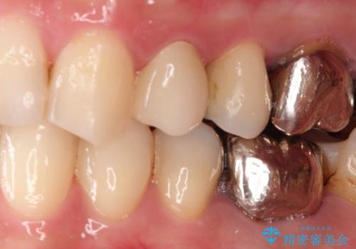 大きい虫歯 根管治療〜オールセラミッククラウンの治療後