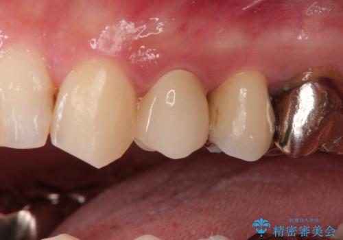 大きい虫歯 根管治療〜オールセラミッククラウンの治療後