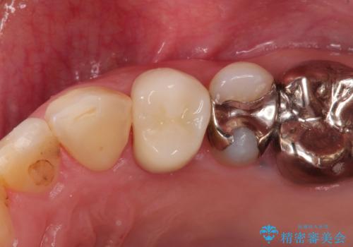 大きい虫歯　根管治療〜オールセラミッククラウンの症例 治療後