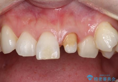 前歯を綺麗にしたい オールセラミッククラウンの治療中