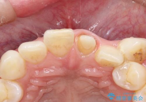 前歯を綺麗にしたい オールセラミッククラウンの治療中