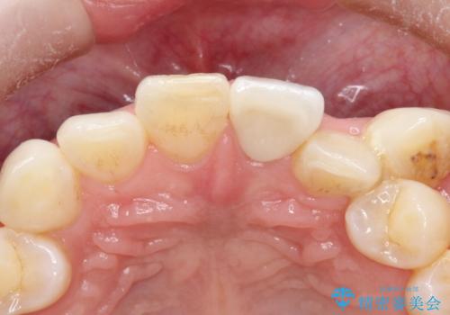 前歯を綺麗にしたい オールセラミッククラウンの治療後