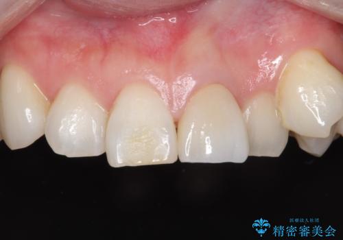 前歯を綺麗にしたい オールセラミッククラウンの治療後