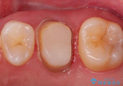 大きい虫歯 根管治療〜オールセラミッククラウンの治療中
