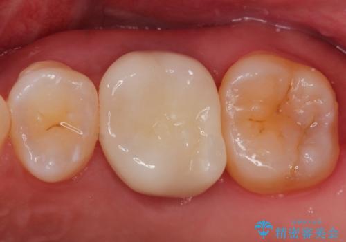 大きい虫歯 根管治療〜オールセラミッククラウンの症例 治療後