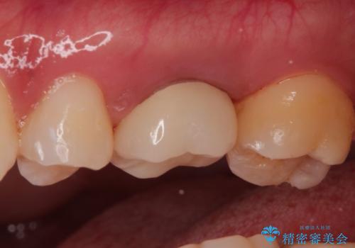 大きい虫歯 根管治療〜オールセラミッククラウンの治療後