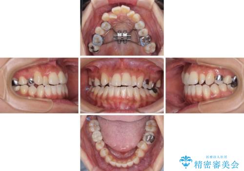 【モニター】幅の狭い上顎歯列 骨幅を拡大する矯正治療の治療中