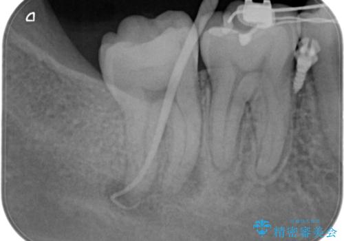 奥の歯茎にニキビみたいなものができた!の治療中