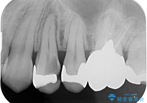 大きい虫歯 根管治療〜オールセラミッククラウンの治療前