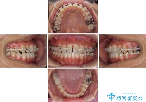 【モニター】幅の狭い上顎歯列 骨幅を拡大する矯正治療の治療中