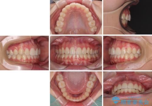 前歯のデコボコを改善 インビザライン矯正の治療後