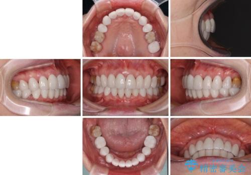出っ歯を改善した後に真っ白な歯に 矯正歯科治療と審美歯科治療の治療後