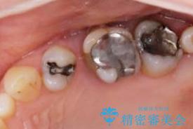 歯周病 ブリッジ補綴の治療前