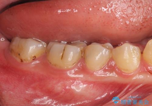 コンポジットレジン修復下で再発する虫歯の治療前