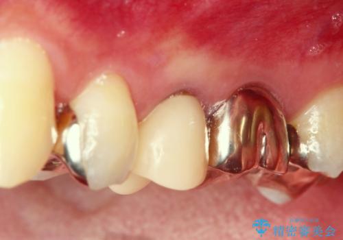 セラミックインレーと根管治療を伴うセラミッククラウンの治療前